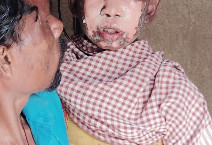 जशपुर ब्रेकिंग: पटाखे से जला,नाबालिग बालक, हालात गंभीर!